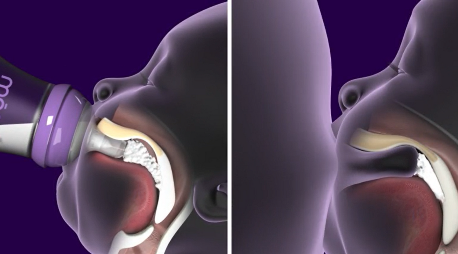 artificial nipple properties & infant oral mechanics